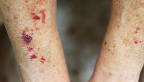 Image result for liver spots on legs