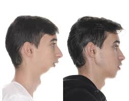 Orthognathic Surgery Program . Dento-maxillo -facial disharmony caused by  Maxilla and Chin(Intraoral sagittal osteotomy, Chin-plasty Program includes  food and accommodation