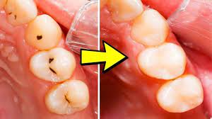 I finished it on wednesday evening. How To Get Rid Of Cavities The Easy Way Doctor Sutera Explains