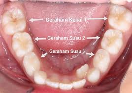 Sakit gigi yaitu sakit pada bagian yang ada disekitar gigi dan penyebabnya itu karena masalah pada gigi bicara soal alat yang digunakan , gigi geraham adalah gigi yang paling sering bermasalah. Medical Mythbusters Malaysia Dia Baru Nak Belajar Berpuasa Tahun Ini Kata Si Ayah Dia Bawa Anaknya Datang Ke Klinik Gigi Mana Tahu Sakit Gigi Pula Dah Dua Hari Susah Tidur Makan