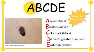 People should tell their doctor if they notice any changes on the skin. Abcde Assessment For Melanoma Skin Cancer