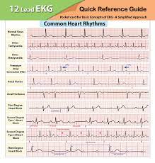 An abnormal ekg can be a sign of heart damage or disease. Ekg Pocket Card Harilal Nair Dnp Aprn 9781941004067 Amazon Com Books