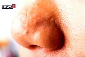From Honey To Sandalwood, Natural Ways To Get Rid Of Oily Nose