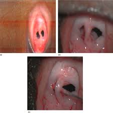 The hymen appears thin, almost translucent in this colposcopic photograph. Hymen An Overview Sciencedirect Topics