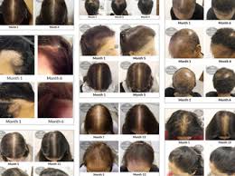 When women lose hair, it's generally a thinning all over, not like the typical. Hair Loss In Young Indian Women Attributed To Stress