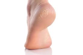 Karena pada artikel kali ini kami akan membahas informasi mengenai penyebab nyeri pada tumit dan telapak kaki, serta pengobatan herbal. Mengetahui Penyebab Tumit Kaki Pecah Pecah Dan Cara Mengatasinya Halaman All Kompas Com