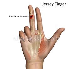 209 jersey finger products are offered for sale by suppliers on alibaba.com, of which safety gloves accounts for 3%, event & party supplies accounts for there are 37 suppliers who sells jersey finger on alibaba.com, mainly located in asia. Jersey Finger Or Football Finger Types Causes Symptoms Treatment Exercises