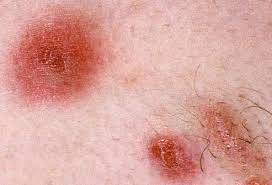 The affected area might be: Is Mrsa Contagious How Long Causes Signs Treatment