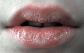 Itu membuat bibir anda lebih kering karena air liur cenderung menguap dengan cepat. Cerita Saya Kesihatan Dan Kecantikan 10 Sebab Bibir Jadi Hitam Kusam Punca Menyebabkan Wajah Hilang Seri