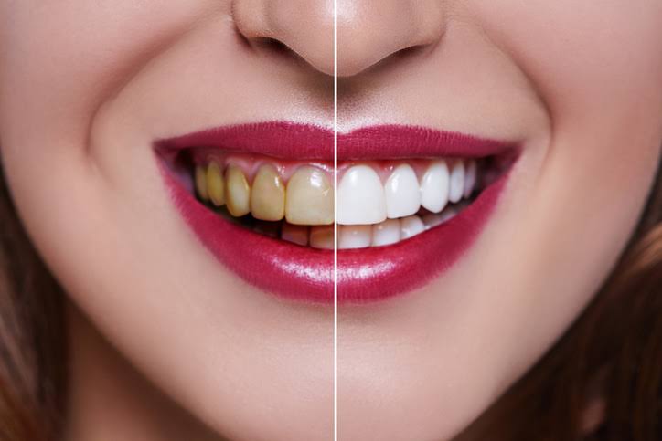 Teeth whitening product image