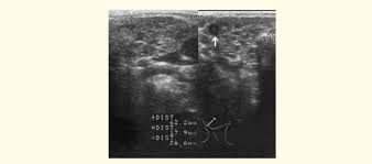 Image result for Sialoadenitis