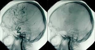 Understanding Brain Death Finger Lakes Donor Recovery Network
