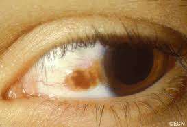 Image result for melanosis sclera