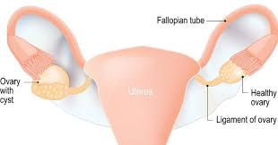 Polycystic ovary syndrome, or pcos, is the most common endocrine disorder in women of reproductive age. Warum Das Pco Syndrom Pcos Oft Lange Unerkannt Bleibt