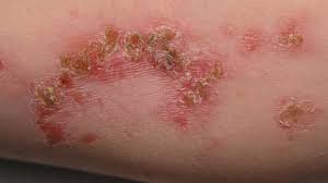Skin Infections