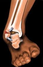 În plus, sportivii în formă bună poate. Fractura De GleznÄƒ Ortopedia Pe InÅ£elesul Tuturor