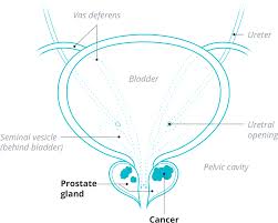 Once a doctor makes a diagnosis of prostate cancer, complications from metastasis will depend on where the cancer spreads to, and how quickly it is growing. Myovant Sciences Focus Area Prostate Cancer