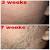 Vellus Vs Terminal Hair Beard