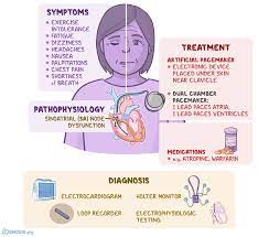 Sick Sinus Syndrome What Is It Symptoms Causes Diagnosis Treatment And More Osmosis