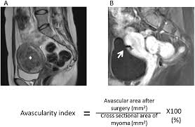 Myomectomy procedure often relieves fibroid symptoms just as well as removing the whole womb (hysterectomy) does. Suturing Method As A Factor For Uterine Vascularity After Laparoscopic Myomectomy European Journal Of Obstetrics And Gynecology And Reproductive Biology