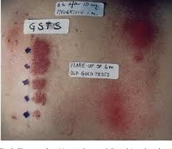 And all because of the fact whether there is an allergy on gold? Clinical Response To Gold As A Circulating Contact Allergen Semantic Scholar