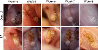 Maybe you would like to learn more about one of these? Intraoral Images Of Extraction Sites In Control Vs Za Treated Rats Download Scientific Diagram