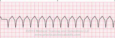Jason winter @ ecg educator download the ventricular tachycardia template to learn ventricular tachycardia (vtach) | circulatory system and disease. Matters Of The Heart V Tach Patmac Rn