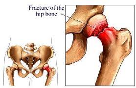 Image result for ‫پوکی استخوان (۱)‬‎