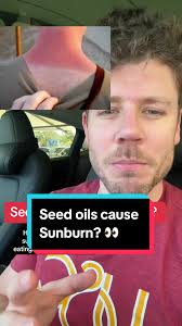 Debunking the Myth: Seed Oils & Sunburn Protection