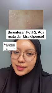 Cara Mengatasi Beruntusan Putih dengan Benar dan Aman