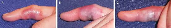 Image result for yellow sac spider bite skin