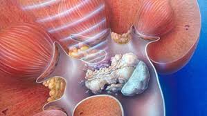 Renal Kidney Stones Diseases And Conditions Pediatric Oncall