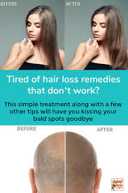 If your hair is dry, you can. Coconut Oil For Hair Loss Hybrid Rasta Mama