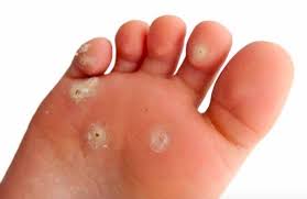 Soigner ampoule pied remede grand mere voici comment soigner les ampoules aux pieds naturellement 8 remedes de grand mere pour soigner vos talons fendus 1 10 Astuces Pour Vous Debarrasser Des Ampoules Et Des Cors