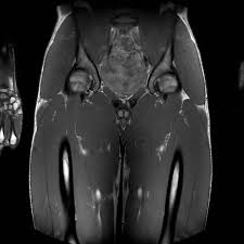 Image result for Pubic Apophysitis