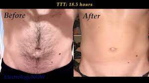 Like electrolysis, this treatment targets the hair follicle. Male Abs Hair Removal Youtube