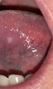 Examining your throat may help you recognize unusual growths. Oral Cancer Fact Versus Fiction Dentistry Today