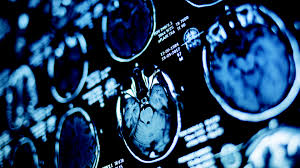 My wife was diagnosed with breast cancer in 97 at 31 years old. Lung Cancer And Brain Metastases Roy Castle Lung Cancer Foundation