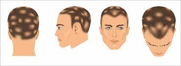 Medication Induced Hair Loss L Parsa Mohebi - Parsa Mohebi Hair Restoration