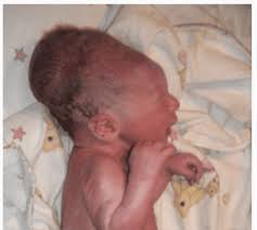 Image result for Vacuum Caput