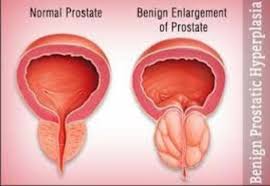 Di dalam wanita, penyakit ini lebih kerap berlaku disebabkan struktur khas sistem genitouriner. Nutrilite Malaysian Chapter Prostat Masalah Kencing Tak Lawas Kencing Yang Tidak Lawas Di Kalangan Lelaki Biasanya Disebabkan Oleh Masalah Prostatitis Radang Prostat Atau Kencing Kotor Jangkitan Kuman Pada Pundi Kencing Batu