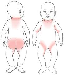 Image result for sweat rash on back baby