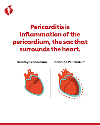 Image result for Pericarditis