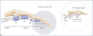 Flexor zone ii is defined as the region spanning the proximal aspect of the a1 pulley to the insertion of the flexor digitorum superficialis (fds) tendon. Flexor Tendon Injuries Musculoskeletal Key
