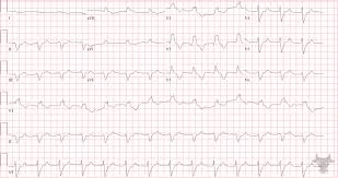 Image result for Right Bundle Branch Block