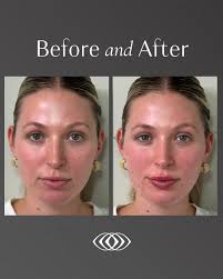 Subtle, sculpted, and beautifully balanced ✨ This transformation by Amiee  Morgan, one of our expert injectors, shows the power of strategic filler  placement