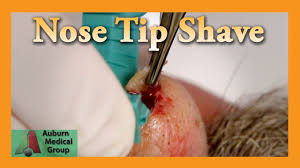 A procedure in which a skin abnormality and a thin layer of surrounding skin are removed with a small blade for examination under a microscope… background shave biopsy of cutaneous lesions is simple, efficient, and commonly used clinically. Nose Shave Biopsy Results In A Brown Noser Auburn Medical Group Youtube