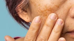 Image result for Melasma calycinum