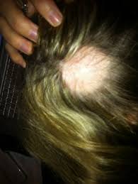 Sleek, straight hairstyles make thinning hair more obvious. Sudden Hair Loss Hits Millions Of Women And No One Knows Why Daily Mail Online