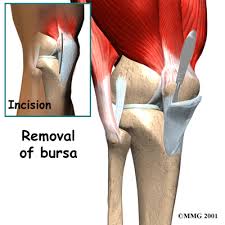 Image result for Prepatellar Bursa Injection